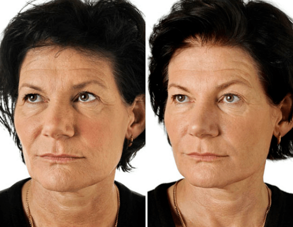 Yüzün kesirli gençleşmesinin sonucu