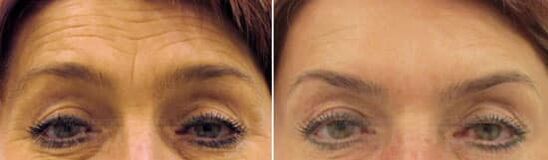 Alnın saha gençleşmesi