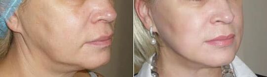 Prosedürü uyguladıktan sonra fotoğraf