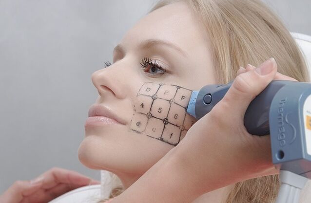 Thermage prosedürü