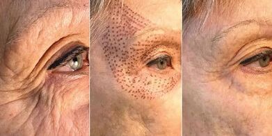 plazma cilt gençleştirme öncesi ve sonrası fotoğraflar